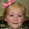 Dilgeline (urtikarija).jpg
